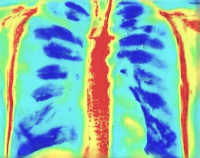Vibrome® GenAI-generated chest radiograph, frontal view — no-radiation tuberculosis imaging