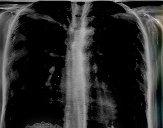 Vibrome® GenAI-generated chest radiograph, lateral view — no-radiation tuberculosis imaging
