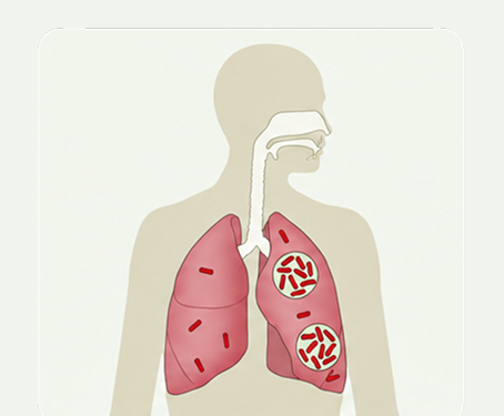 TB disease-severity spectrum — easier-to-treat lungs with lower bacterial burden, tuberculosis host-response illustration