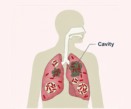 TB disease-severity spectrum — harder-to-treat lungs with cavities and higher bacterial burden, tuberculosis illustration